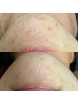 シエル 美里店(ciel)/Revi★陶肌トリートメント