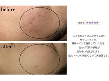 チューズ 北参道 代々木店(CHOOSE)の雰囲気（ピーリングで肌質◎フォトギャラリーご覧下さい!(北参道/代々木)）