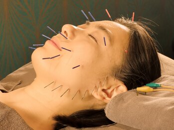 天使のたまご 新宿院の写真/リフトアップ鍼でむくみ/くいしばり解消！フェイスラインもすっきり！美容鍼の相乗効果で美肌力アップ◎