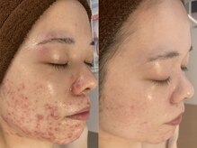 エヌエースキン 横浜店(NAskin)/ハーブピーリング｜ニキビケア