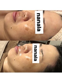 ナナラ(nanala)/韓国水光肌フルコースエステ