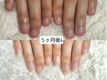 グラシナ なんば店/深爪/自爪育成/フィルイン