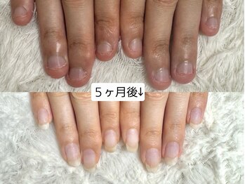 グラシナ なんば店/深爪/自爪育成/フィルイン