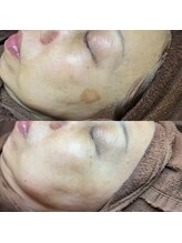 ホワラ 横浜店(Whila)/施術効果7