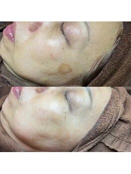 ホワラ 横浜店(Whila)/施術効果7