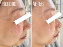 煌(kirameki)/【たるみ】毛穴洗浄＋micostella