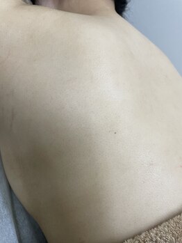 ナノハナ/鹿沼市の全身脱毛のナノハナ