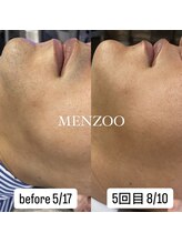 メンズー(MENZOO)/