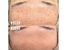 ベレッツァ 恵比寿(BELLEZA)の雰囲気（本気の肌質改善/肌荒れ改善コース）