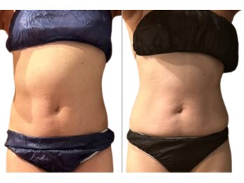 サロンドモフィ(salon de moffy)/痩身【脂肪冷却】おなか施術例４