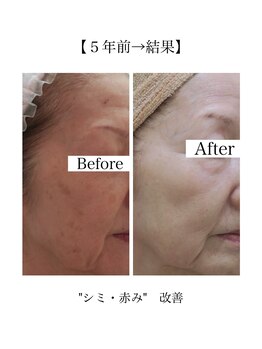 スマートポッシュ(Smart posh)/【シミケア】before→after