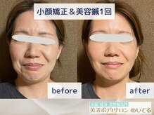 めいてるの雰囲気（小顔矯正と美容鍼のセットが人気！極細鍼で痛みの少ない美容鍼♪）