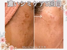 マリスステラ 天王寺(MarisStella)/フェイシャル５回/天王寺エステ