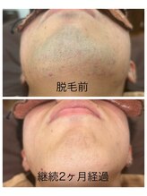 アカラ 読谷店(AKALA)/ヒゲ脱毛2ヶ月経過