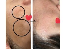 ルカシエ(Le Cacie)/50代女性/年齢シミ改善