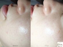 凛美庵の雰囲気（エクソソーム施術　before⇒after　♪♪）