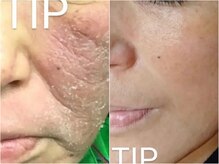 ルノン(Lunon)/肌質改善　《症例》