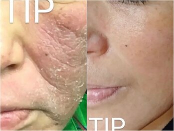 ルノン(Lunon)/肌質改善　《症例》