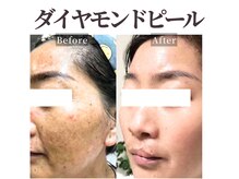 癒える(ielu)の雰囲気（New★韓国発！ダイヤモンドピールで諦めていた跡残りニキビケア）