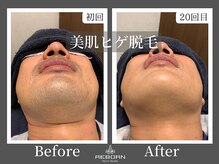 メンズスタジオ リボーン(REBORN)/顔脱毛/ひげ脱毛/松山