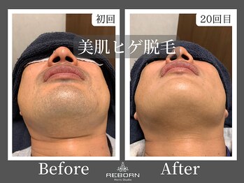 メンズスタジオ リボーン(REBORN)/顔脱毛/ひげ脱毛/松山