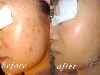 パールホワイトニング/目立ったシミ改善