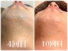 【脱毛】ご予約の際は必ずご連絡ください◆男性専用★髭脱毛　１回　4950円　