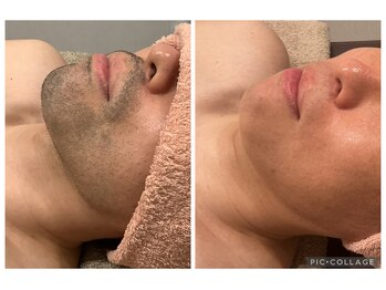 ラ ボーテ(La Beaute)/大人気!メンズヒゲ脱毛