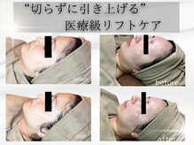 切らずに引き上げ小顔リフト！整形級ケア☆【小顔/たるみ】
