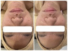 エヌ(enu)/ハーブピーリング/フェイシャル