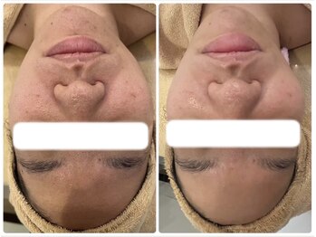 エヌ(enu)/ハーブピーリング/フェイシャル