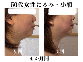 ランティル(l’until)の写真/ダイエットでも落ちない顔の脂肪。輪郭からはみ出る脂肪。二重アゴの脂肪を分解。たるみもスッキリ解決！
