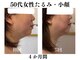 ランティル(l’until)の写真/ダイエットでも落ちない顔の脂肪。輪郭からはみ出る脂肪。二重アゴの脂肪を分解。たるみもスッキリ解決！