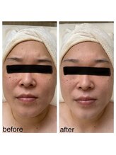 エナッシュビューティサロン(ENASH)/光フェイシャル