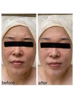 エナッシュビューティサロン(ENASH)/光フェイシャル