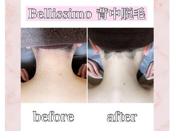 ベリッシモ 酒田店(Bellissimo)/☆美肌脱毛ビフォーアフター☆