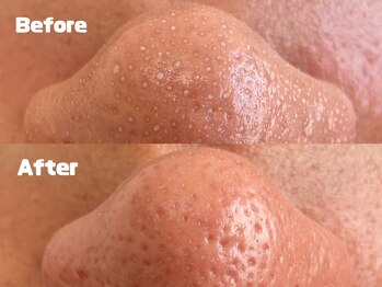 ベルカーラ(Belcarra)/毛穴洗浄ハイドロピーリング