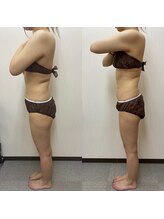 ビオルブ(VIOLVE)/痩身施術前ビフォー・アフター