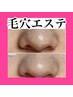 【毛穴の黒ずみザラつきテカリ解消】+デコルテマッサージ　¥13.000→¥11.000