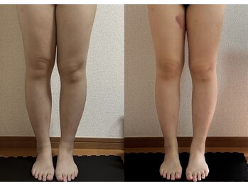 リノリー 一関店(rinory)/瞬冷スリムボディケア♪