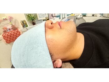 ミライズ(MIRAI'S)/脱毛で清潔感UP☆☆☆(^▽^)