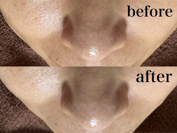 フェイシャルサロン アリイ(ALII)/毛穴美人症例