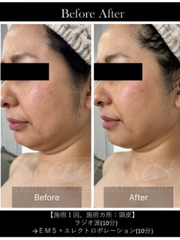 メルシー(Merci)/小顔と美肌を同時に手に入れる♪