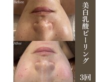 サロンドペシェ(salon de peche)/美白乳酸ピーリング3回の変化