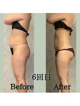 リンガ(Ringa)/ビフォーアフター　【腸活ケア】