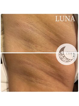 ルーナ(LUNA)/☆脇脱毛3回施術結果☆