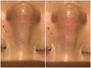 クラン シュプール 表参道店/【毛穴のつまり/ニキビケア】