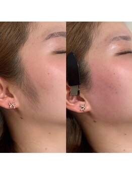 アイブロウドット 姫路(iBROW.)/フェイスラインの部分WAX脱毛