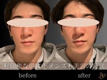 チョコバリ 郡山店(chocobari)/小顔×リフトアップ(美容鍼)20代