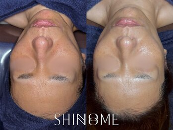 シノノメ(SHINONOME)/*お肌の赤み・くすみ